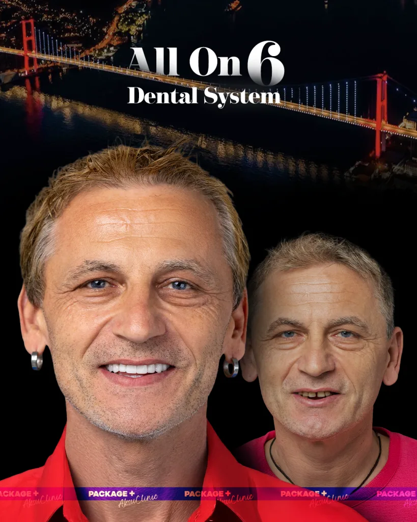 Aksu Clinic All-on-6 Dental System tedavi paketi